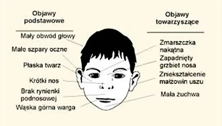 Jak wygląda dziecko z FAS? Poznaj charakterystyczne cechy i objawy
