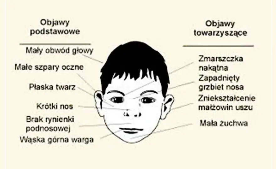 Jak wygląda dziecko z FAS? Poznaj charakterystyczne cechy i objawy