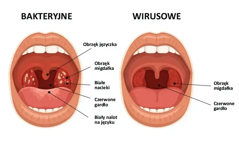 Zdjęcie Skuteczne sposoby na anginę u dziecka – jak ulżyć w bólu i objawach